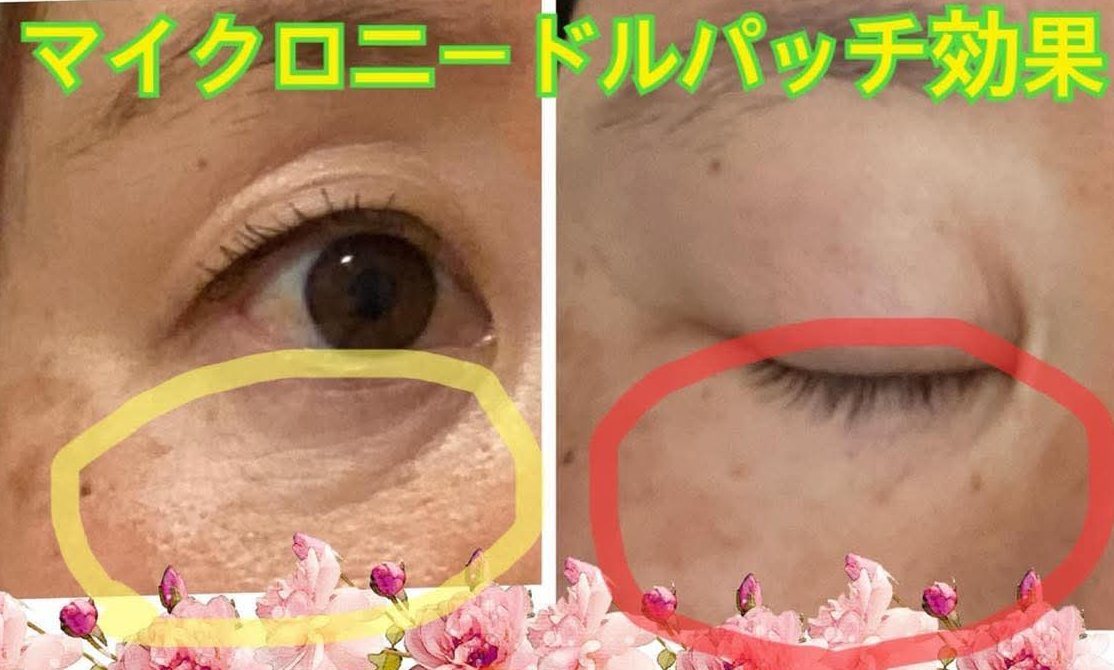 定期購入は3ヶ月ごとに嬉しいおまけつき🎁 7月のプレゼントは、マイクロニードルパッチ✨ 定期購入は3ヶ月ごとに嬉しいおまけつき🎁 7月のプレゼントは、マイクロニードルパッチ✨